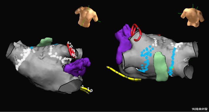 CT Angiogram of the left atrium