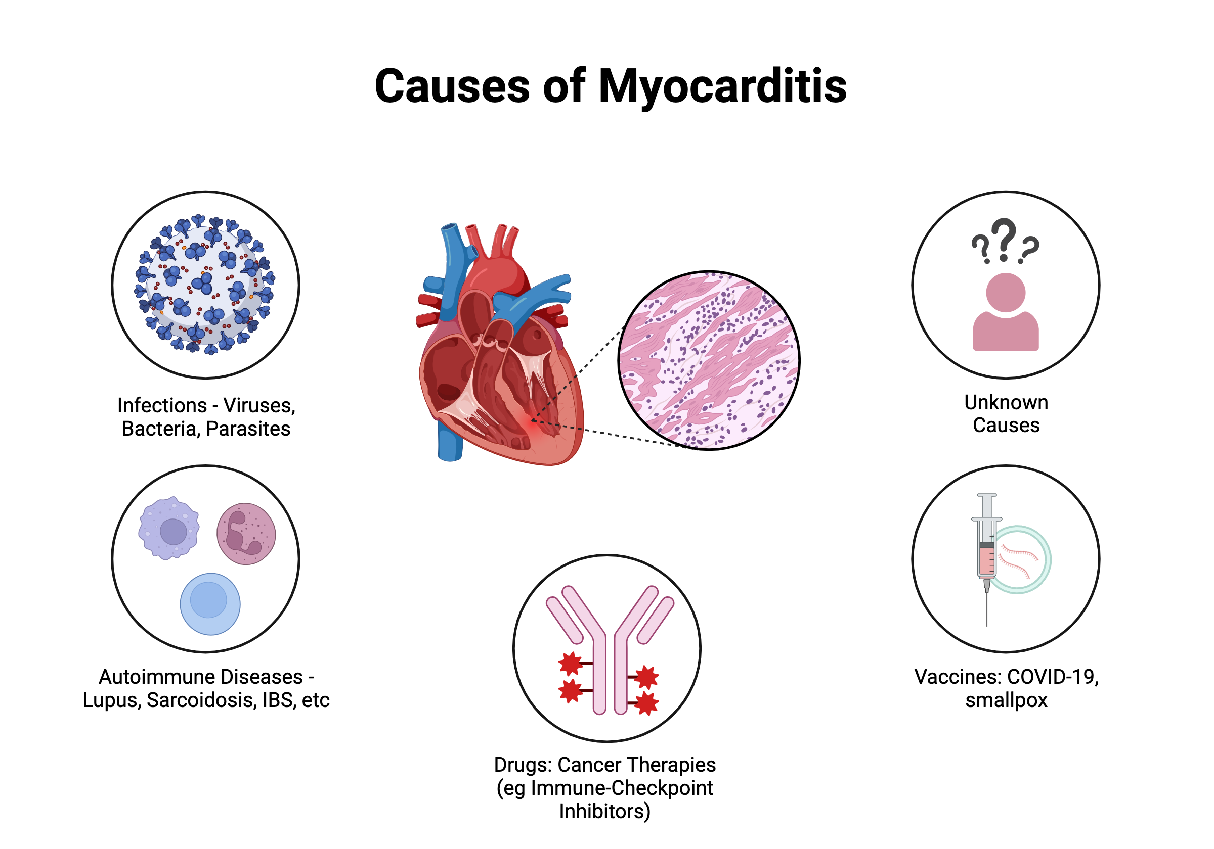 Causes of Myocarditis 