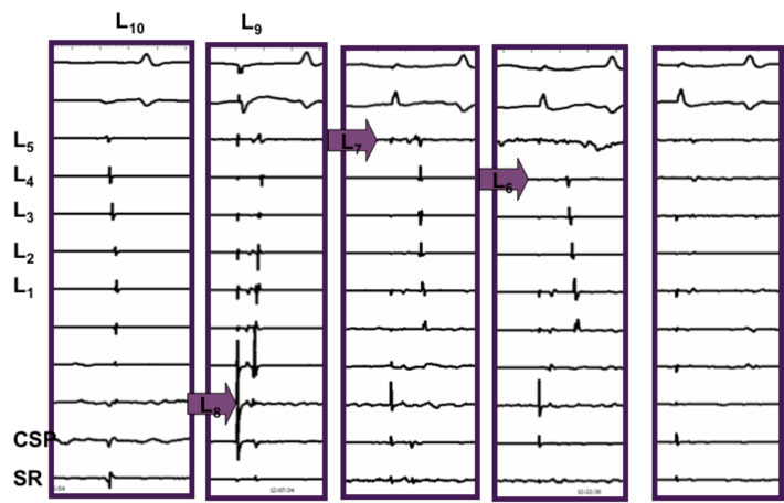 Electrical disconnection of PV by ablating