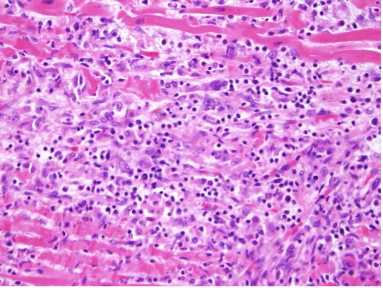 myocarditis