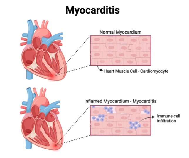 what is myocarditis