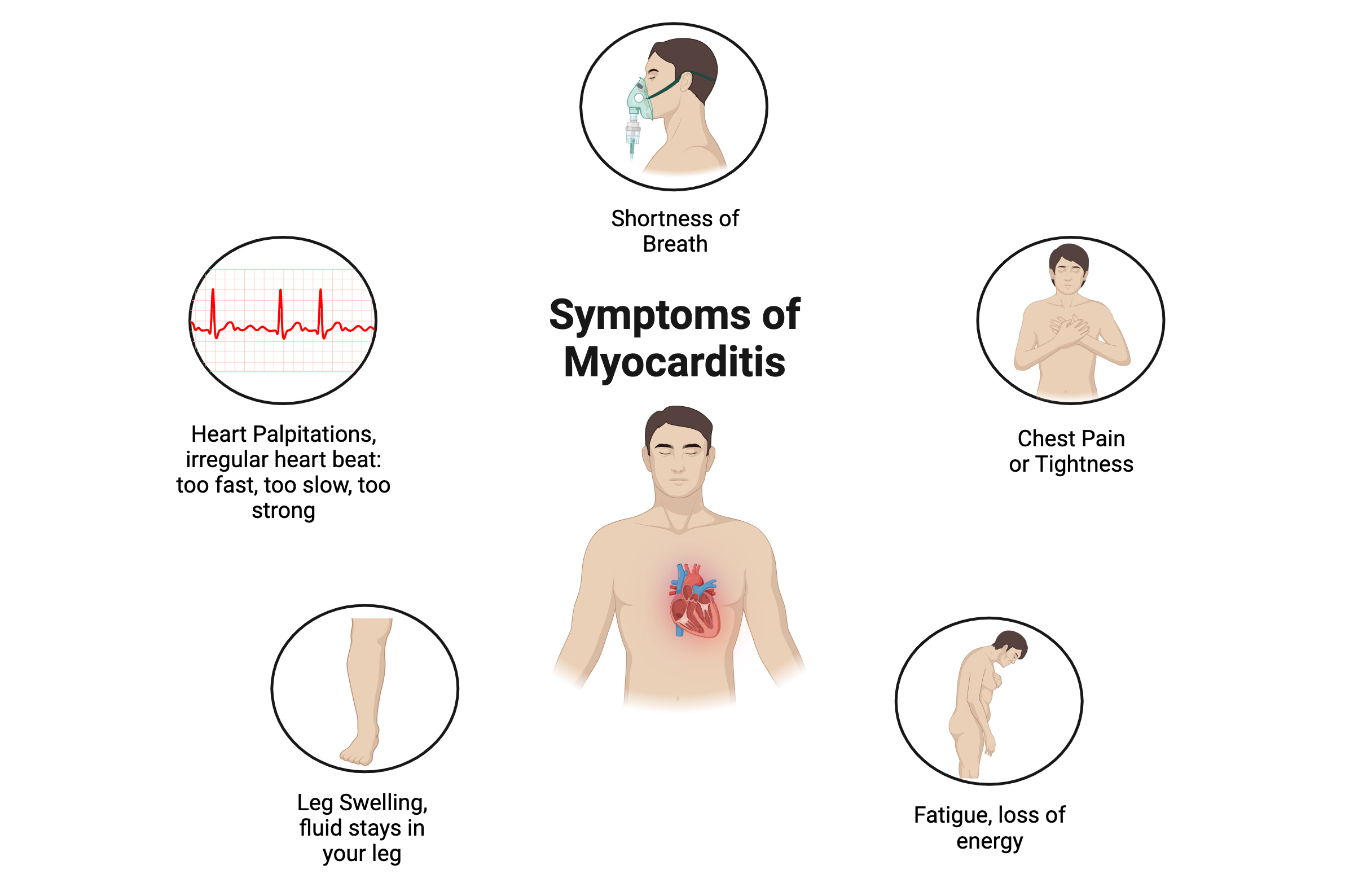 Symptoms of myocarditis