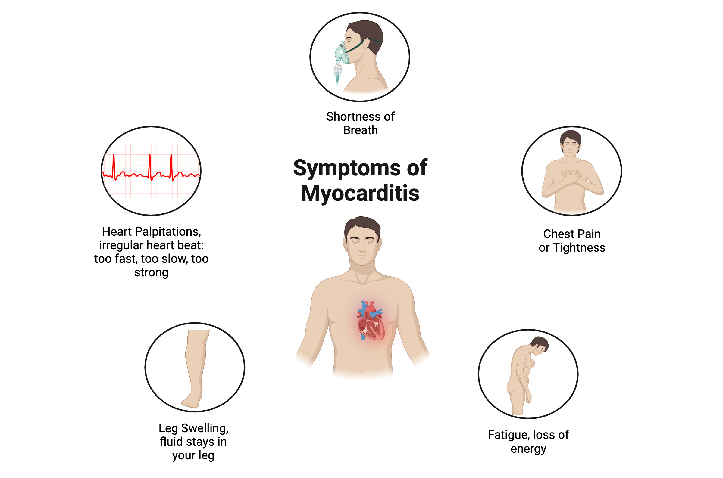 Symptoms of Myocarditsi 