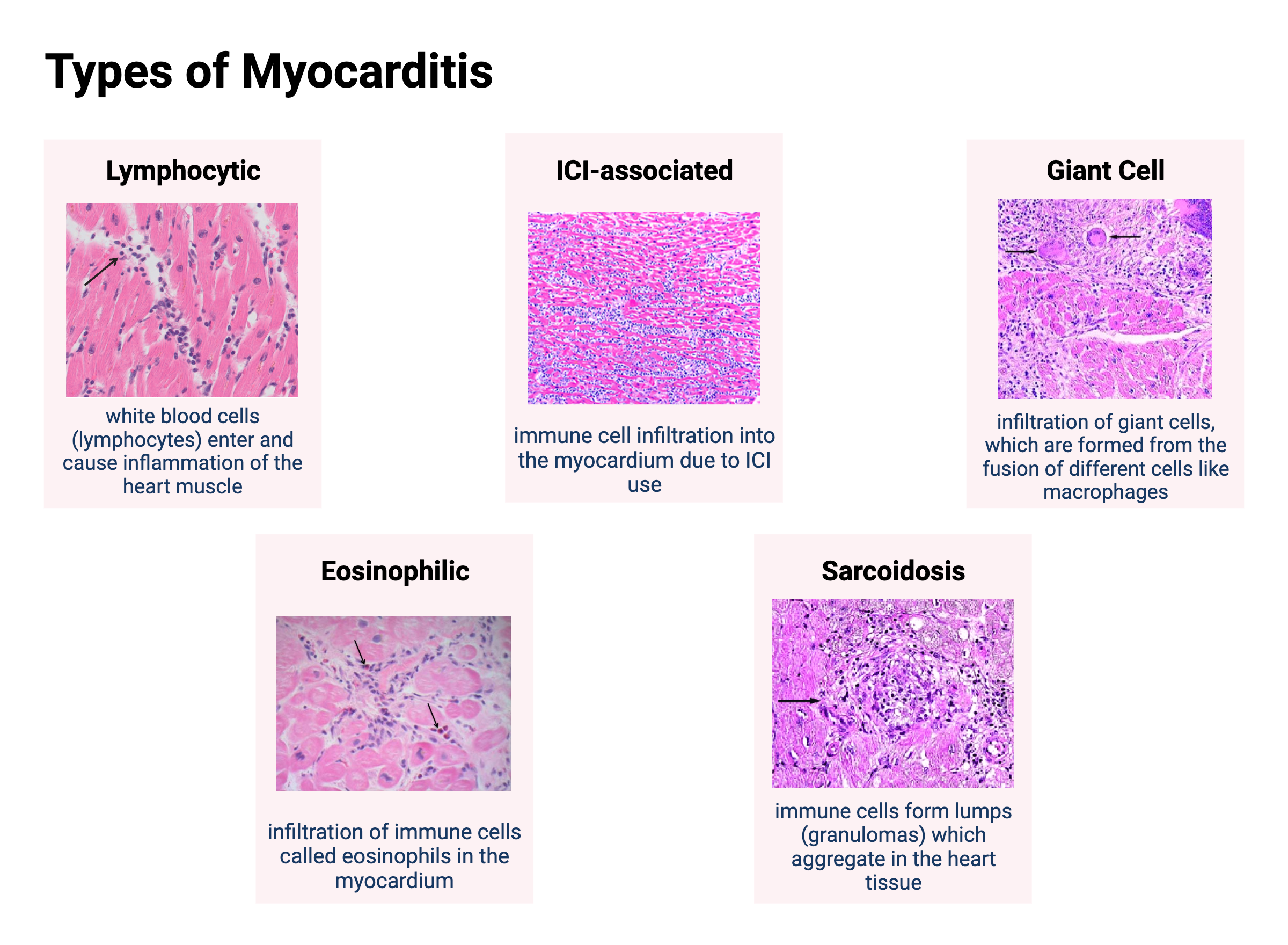 types of myocarditis